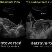 Retroverted Uterus Or Retroflexed Uterus