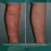 Varicose Vein Surgery