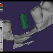 Exocad Сканбоди Geo Medi Scanbody