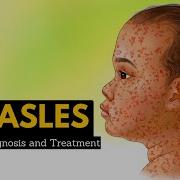 Measles Causes Symptoms Diagnosis Treatment Pathology