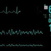 Звуки Мониторов В Реанимации