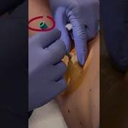 The Disturbing World Of Pimple Popping Pimple Popping Compilation Part 6