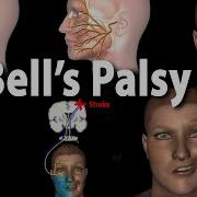 Bells Palsy