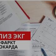 Инфаркт Миокарда Экг