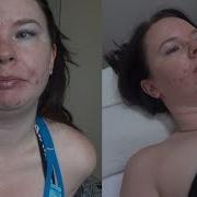 Microdermabrasion Struggling With Acne Vlog 3 Kayla Allure