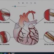 Д Р Юкъл Исхемична Болест На Сърцето
